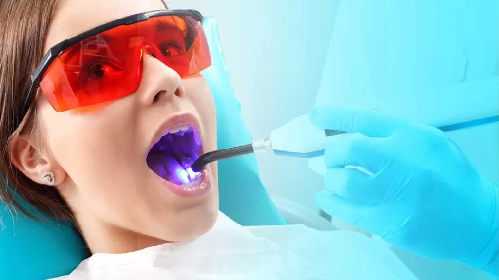 Герметизация фиссур: преимущества процедуры