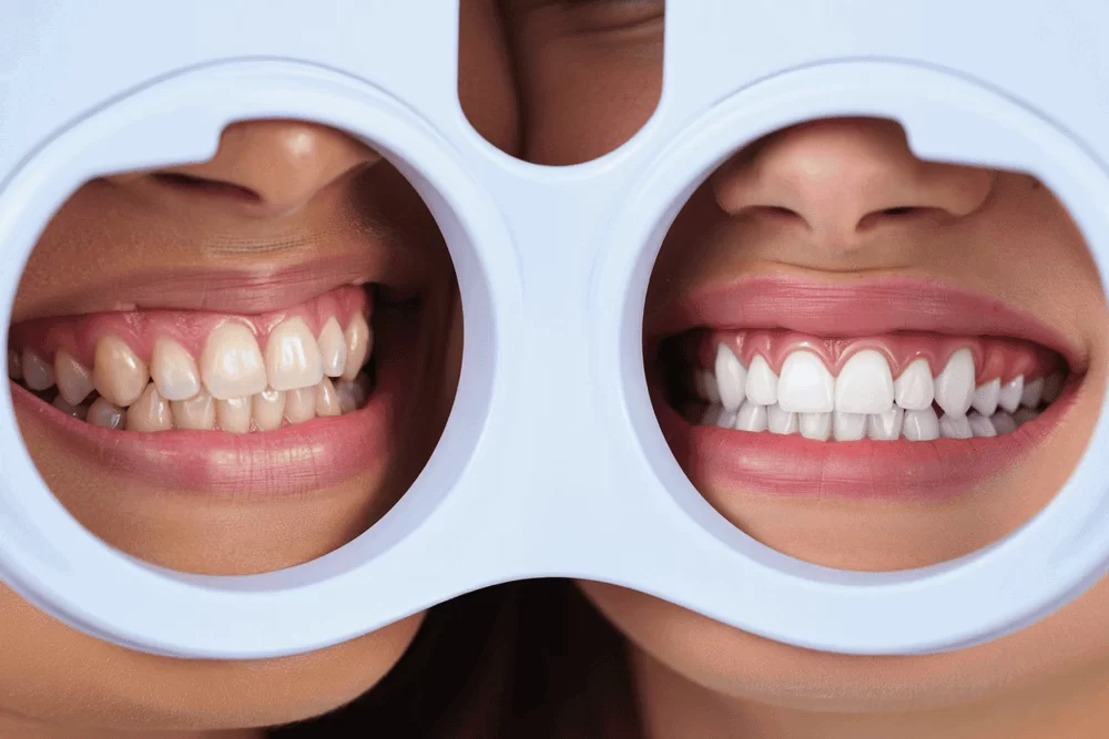 Какие виды отбеливания лучше и безопаснее?