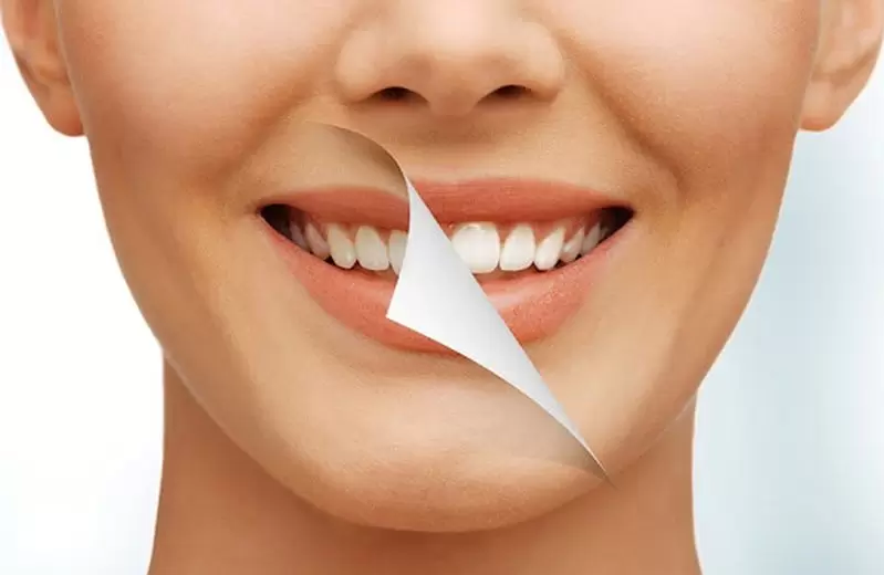 Белоснежные зубы: как отбеливают эмаль?