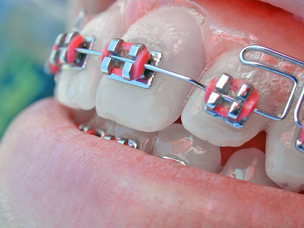Отбеливание зубов: история 8