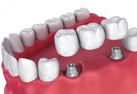 Мостовидные протезы