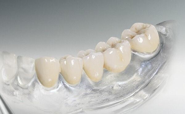 Нейлоновые протезы