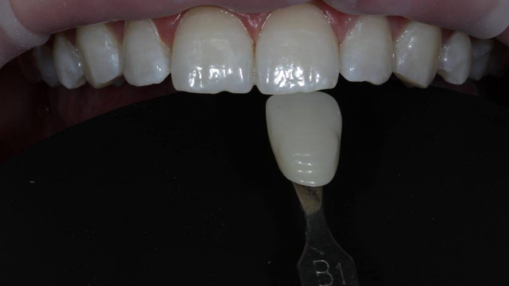 Зубы после фотоотбеливания с фоном
