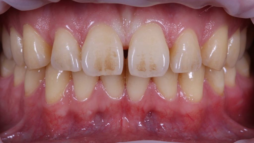 Неухоженные зубы