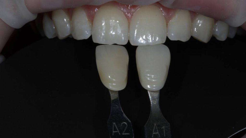 Зубы после фотоотбеливания