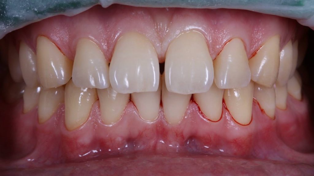 Неухоженные зубы и кровоточащий десна