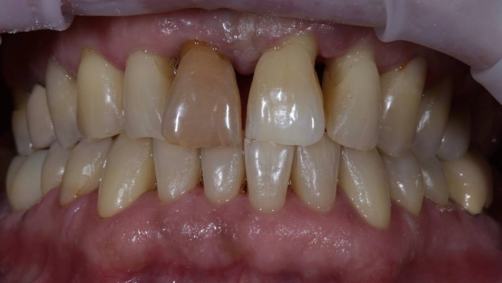Неухоженные зубы