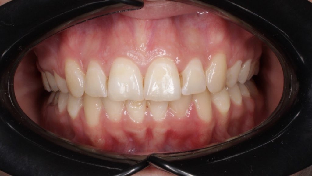 лечение дистального прикуса в стоматологии