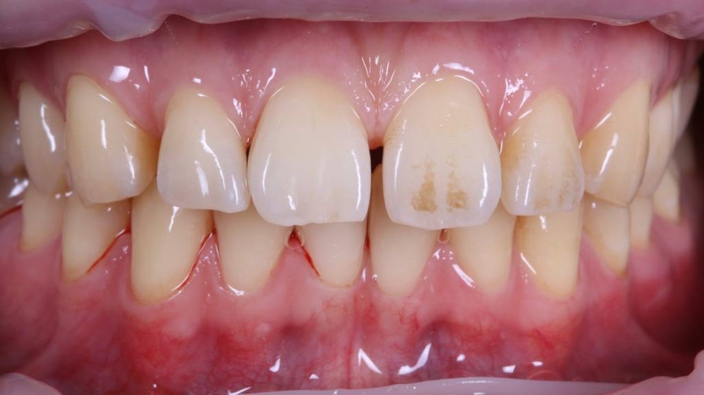 Неухоженные зубы до и после чистки