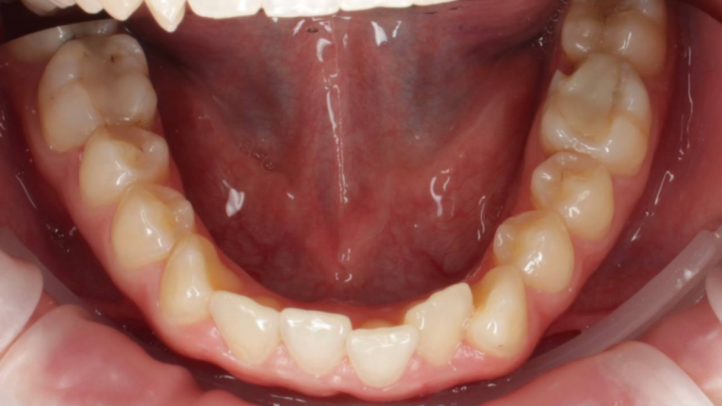 нейтральный перекрёстный прикус зубов - открытый рот