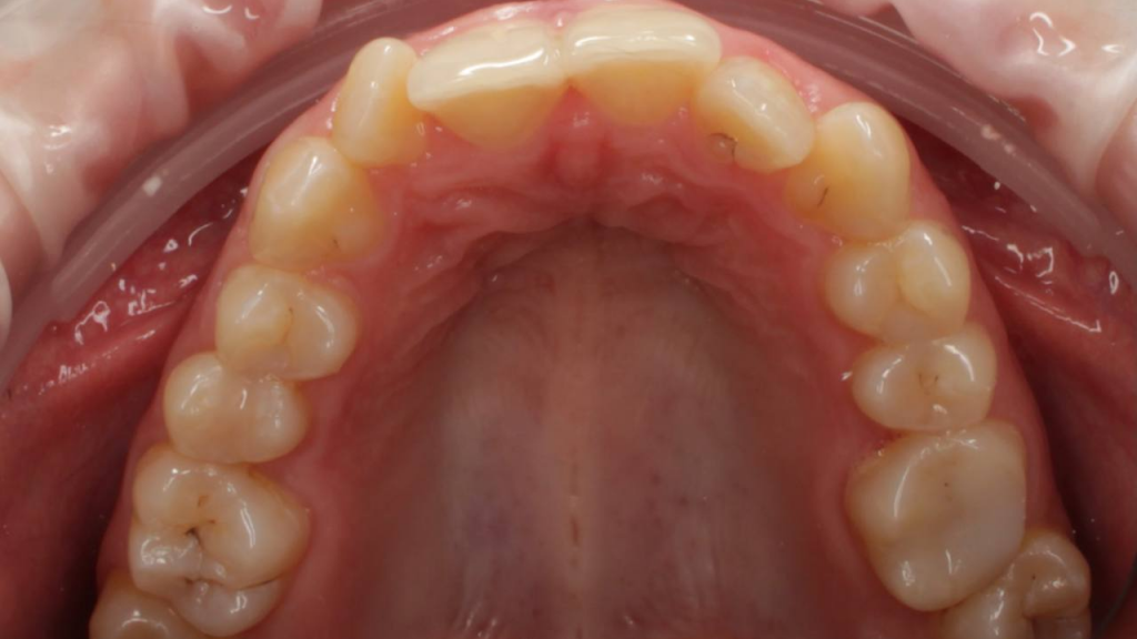нейтральный перекрёстный прикус зубов - верхняя челюсть