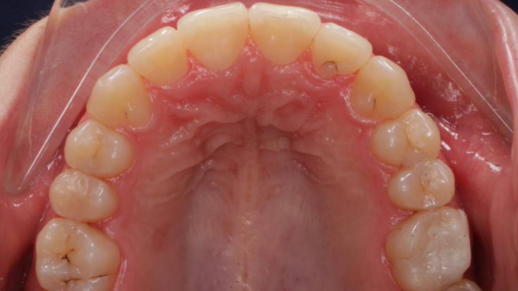 нейтральный перекрёстный прикус зубов - верхняя открытая челюсть