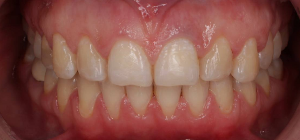 ровные исправленные зубы