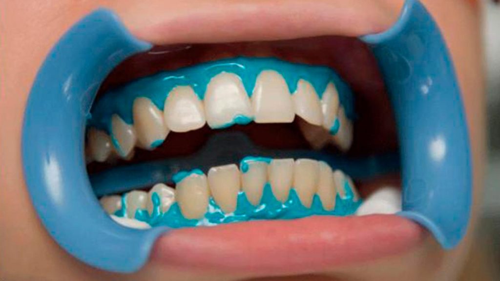 Химическое отбеливание зубов