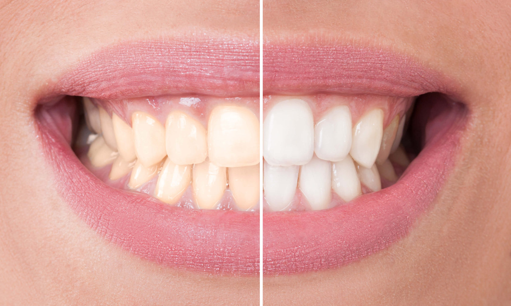 Белоснежные зубы: как отбеливают эмаль?