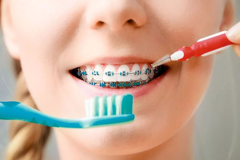 Как чистить зубы с брекетами?