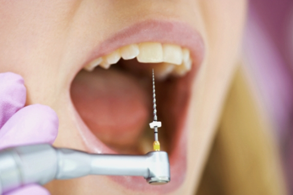 Что нужно знать об удалении зубного нерва?