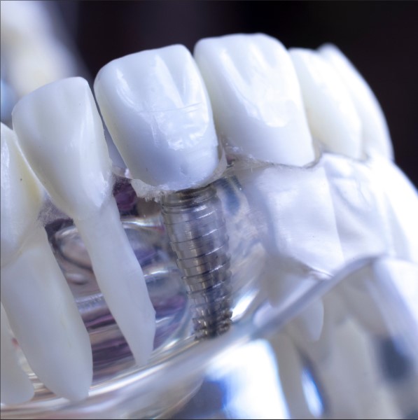 Одномоментная или двухэтапная имплантация зубов: особенности и показания
