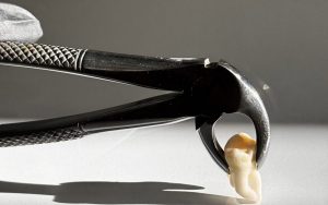 Больно ли удалять зубы мудрости?