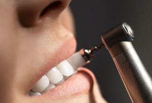 Зачем нужны полировка и шлифовка зубов?