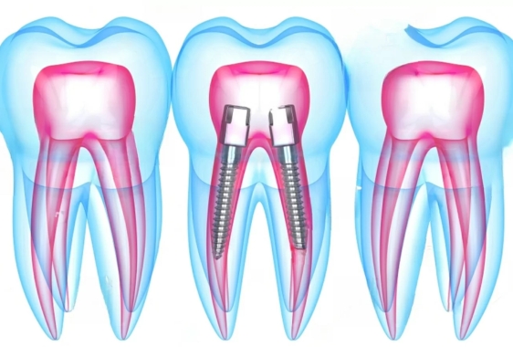 штифт для зуба